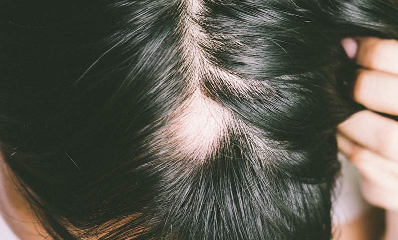 Types of stress-related hair loss: Alopecia aerate