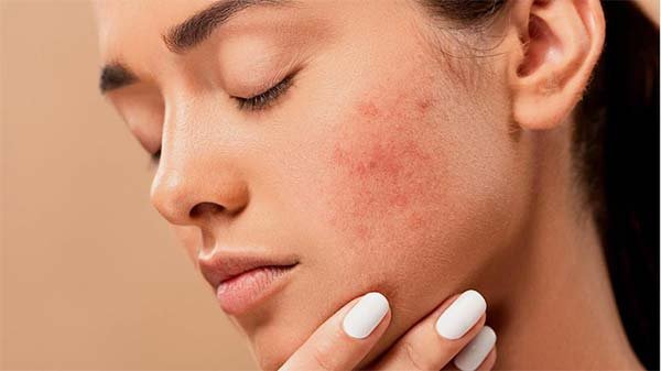 The 12 Benefits of Moisturiser for Face: Help Fight Acne 