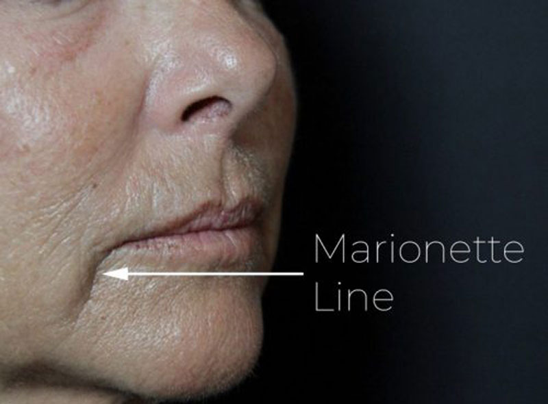 Botox marionette lines technique