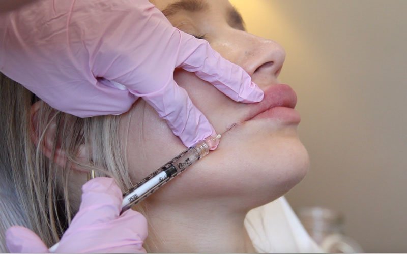 Injections of Lip Filler