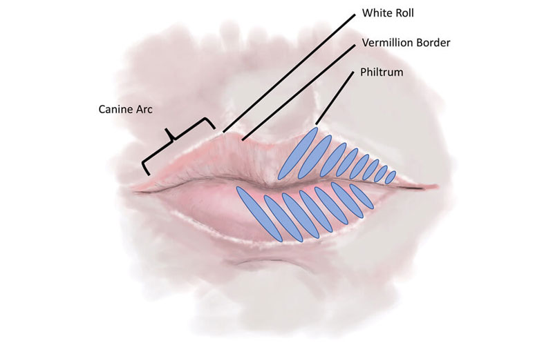 Technique of lip tenting