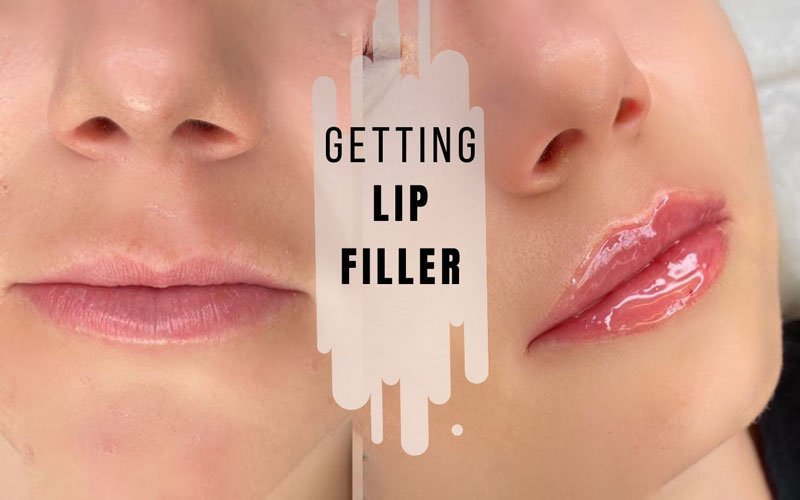 russian lip filler technique: What is lip tenting