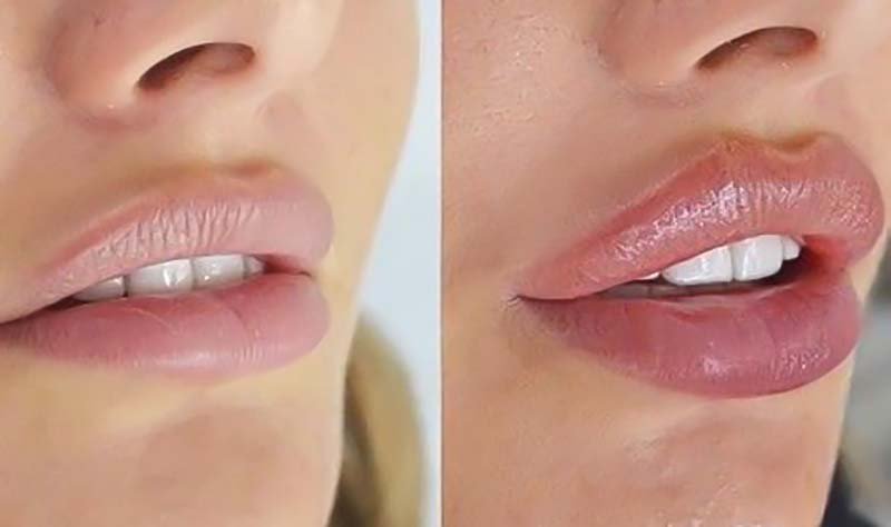 Russian Lip Filler Technique Before and After