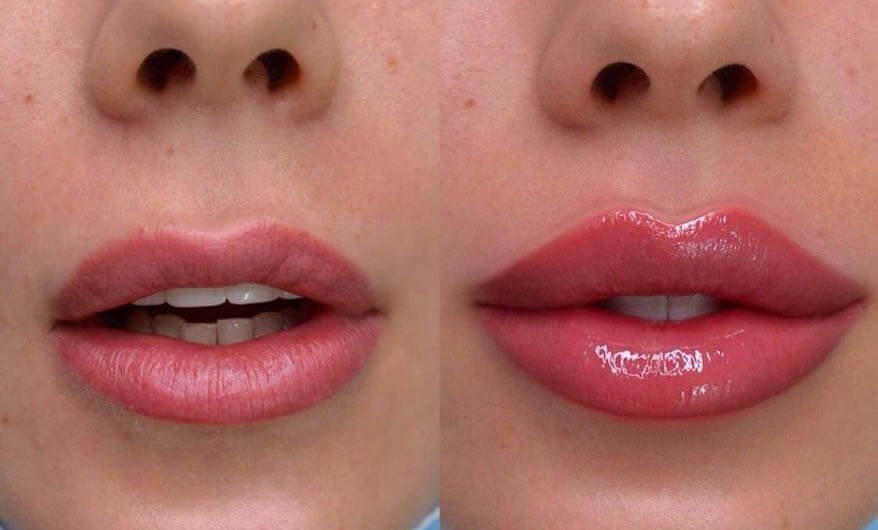 russian lip filler technique
